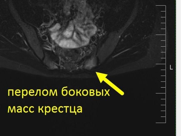 МРТ пояснично-крестцового и крестцово-копчикового отдела позвоночника