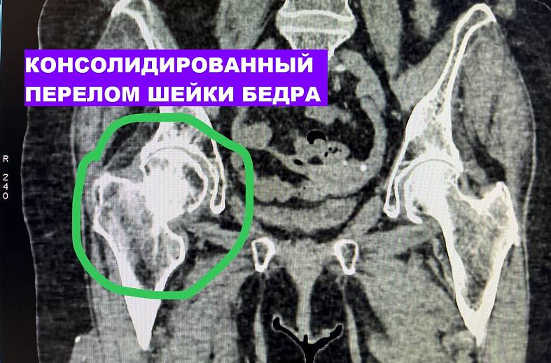 КТ тазобедренного сустава (головка и шейка бедренной кости)