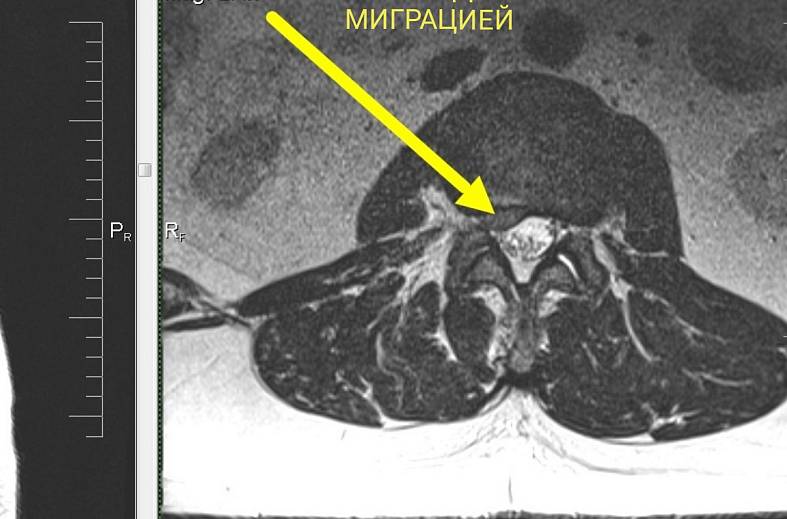 МРТ всего позвоночника (шейного, грудного, пояснично-крестцового отделов)