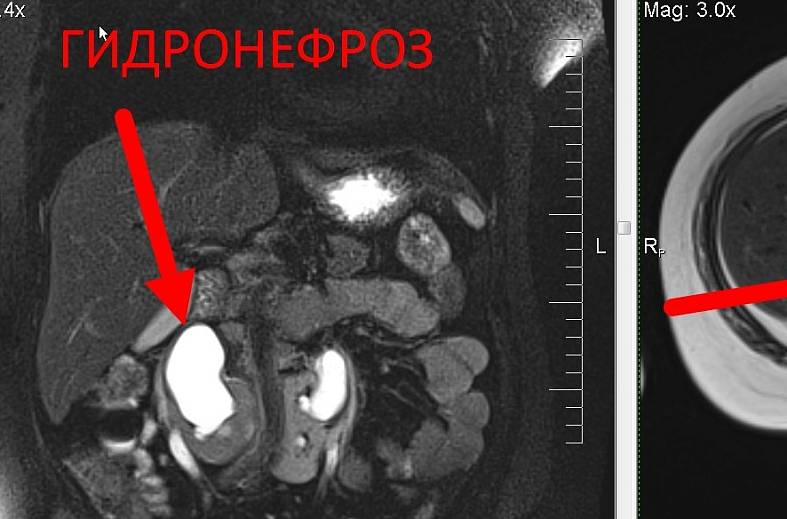 МРТ органов забрюшинного пространства (почки, надпочечники, нижняя полая вена, лимфатические узлы, брюшной отдел аорты)