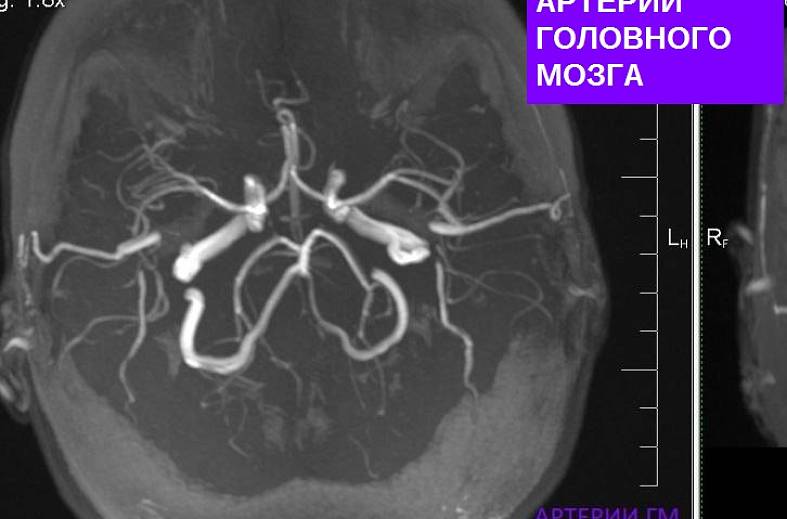 МРТ головного мозга и артерий головного мозга