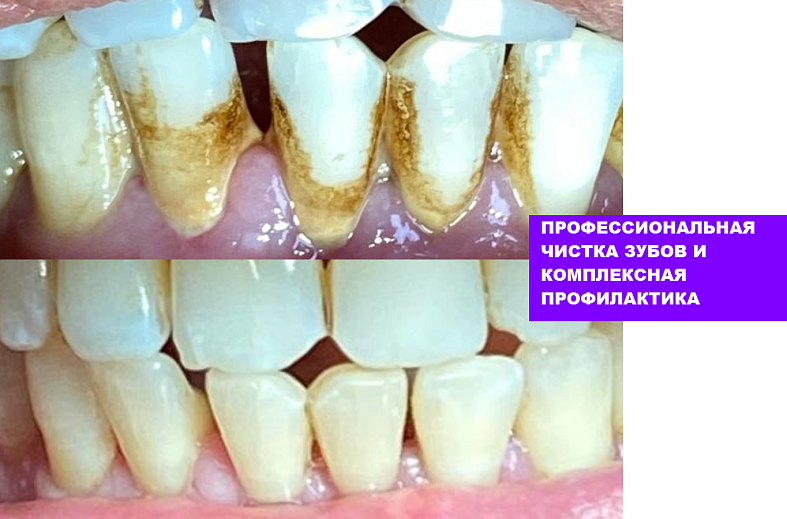Комплексная чистка одного зуба, ультразвуковая и Air Flow