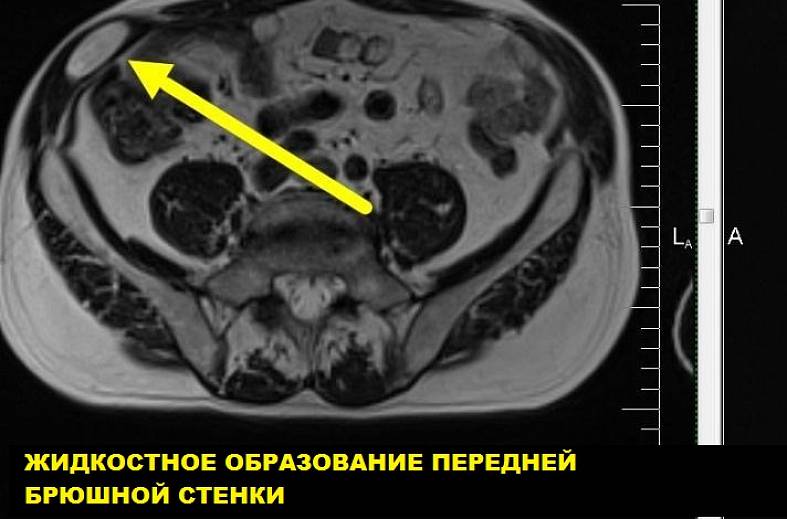 МРТ мягких тканей (одна область)