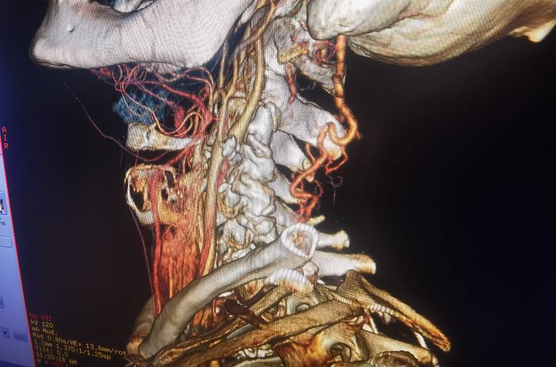 КТ артерий шеи. КТ ангиография брахиоцефальных артерий