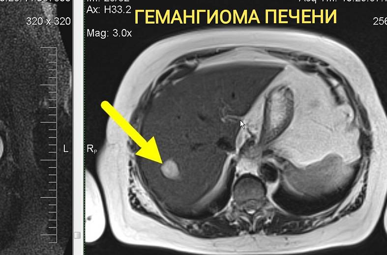 МРТ органов брюшной полости и холангиография (детальный осмотр внутри и вне печеночных желчных протоков)