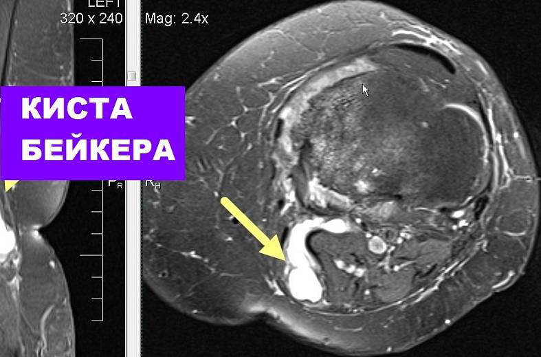 МРТ коленного сустава на 4-х канальной катушке