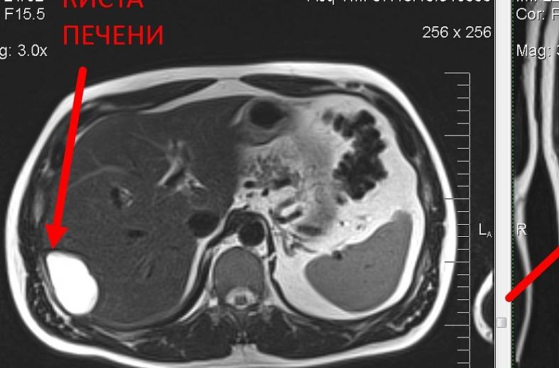 МРТ печени, желчного пузыря и холангиография (детальный осмотр внутри и вне печеночных желчных протоков)