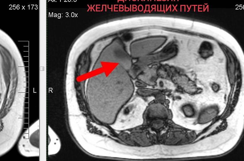 МРТ органов брюшной полости и холангиография (детальный осмотр внутри и вне печеночных желчных протоков)