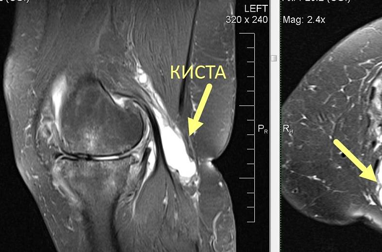 МРТ коленного сустава на 4-х канальной катушке