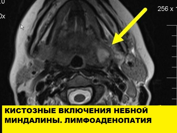 МРТ мягких тканей лицевого черепа