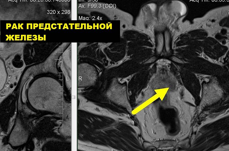 Диффузно-взвешенное магнитно-резонансное изображение (DWI MRI) ( для обеспечивания контрастности картинки)