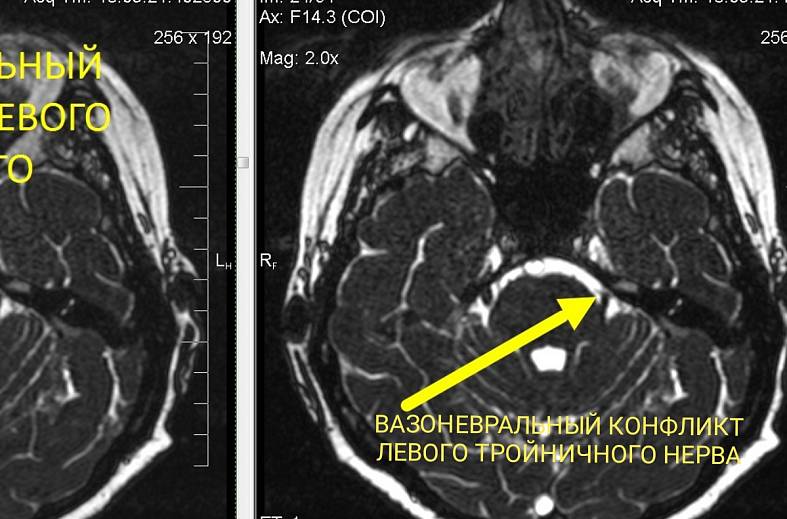 МР-исследование черепно-мозговых нервов (толщина среза 0,3 мм (тригеминальные и лицевые невралгии))