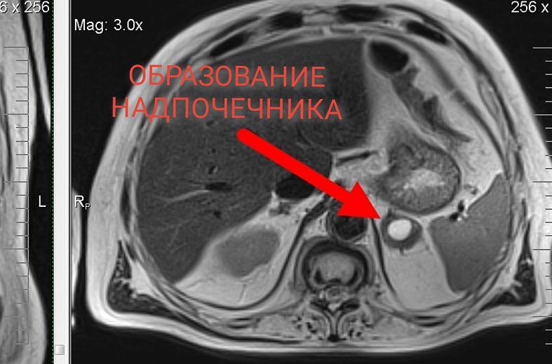 МРТ органов забрюшинного пространства (почки, надпочечники, нижняя полая вена, лимфатические узлы, брюшной отдел аорты)