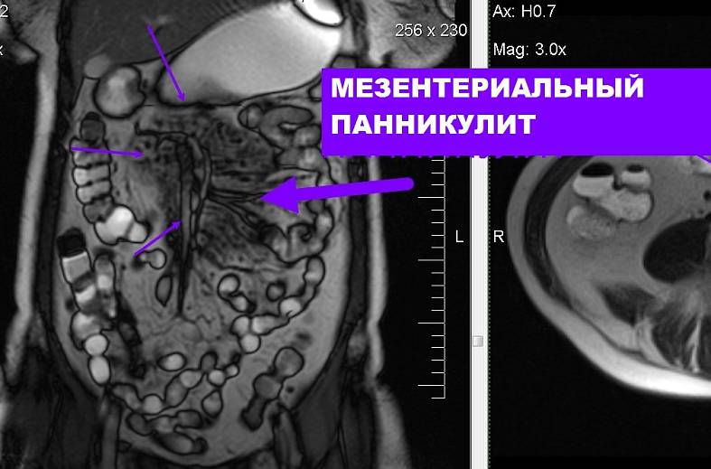 МРТ тонкого кишечника с пероральным контрастированием (препарат Mannitolum) (МР-энтерография)