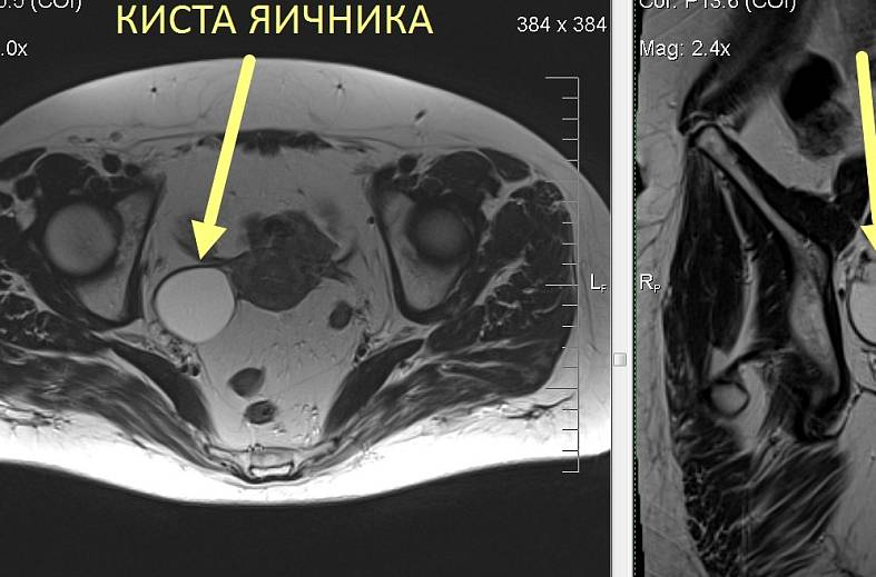 МРТ органов женского малого таза (матка, яичники, мочевой пузырь, влагалище, сосуды малого таза, лимфатические узлы)