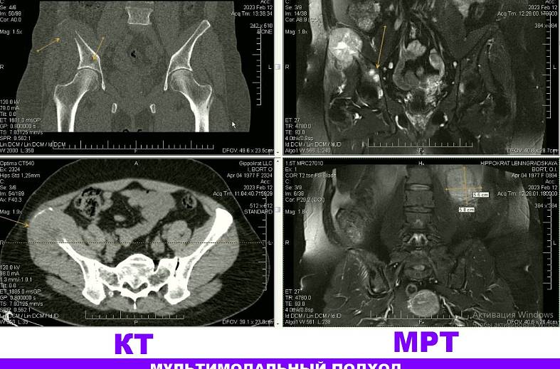 МРТ тазобедренных суставов (пара суставов)