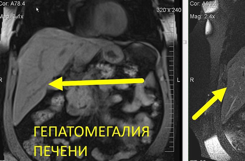 МРТ органов брюшной полости (печень, поджелудочная железа, селезенка, желчный пузырь, нижняя полая вена, брюшной отдел аорты, лимфатические узлы)