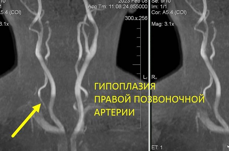 МРТ-исследование артерий шеи