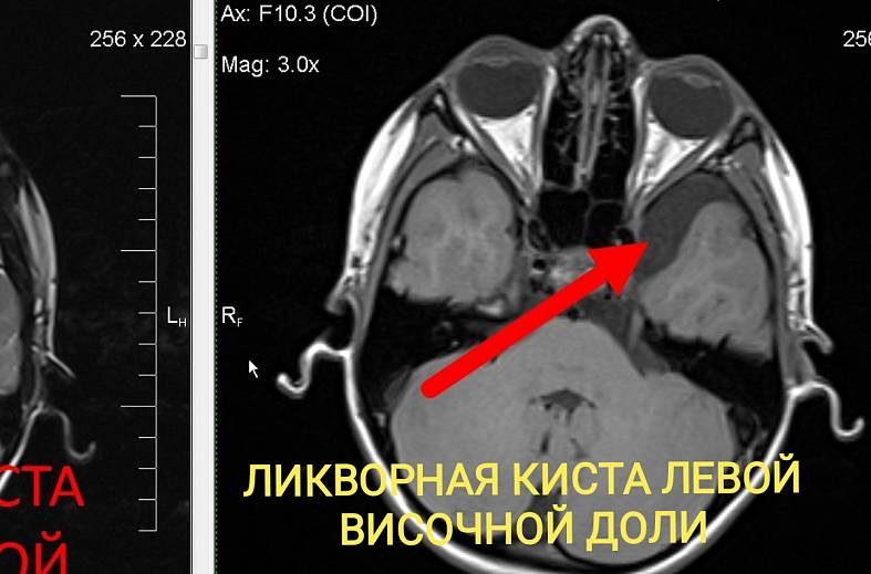Высокопольная МРТ головного мозга по программе эпилептологического сканирования