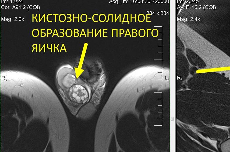 МРТ наружных половых органов (органы мошонки и пенис)