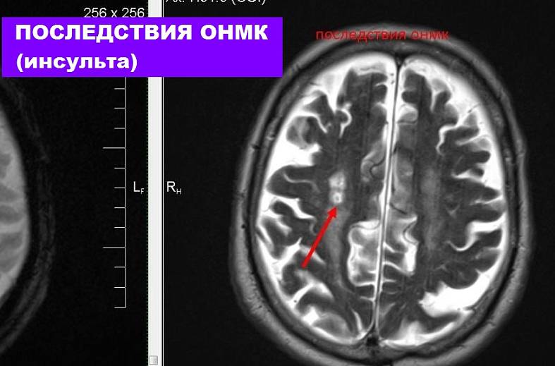 МРТ головного мозга и артерий головного мозга