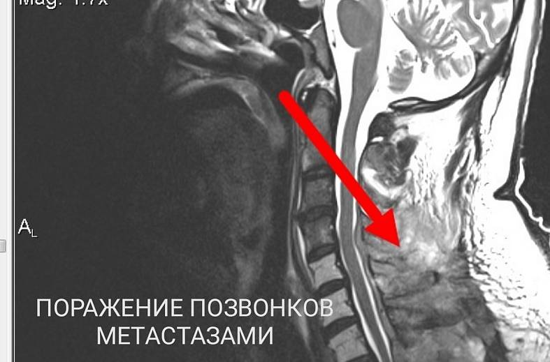 МРТ шейного отдела позвоночника и ангиография артерий шеи