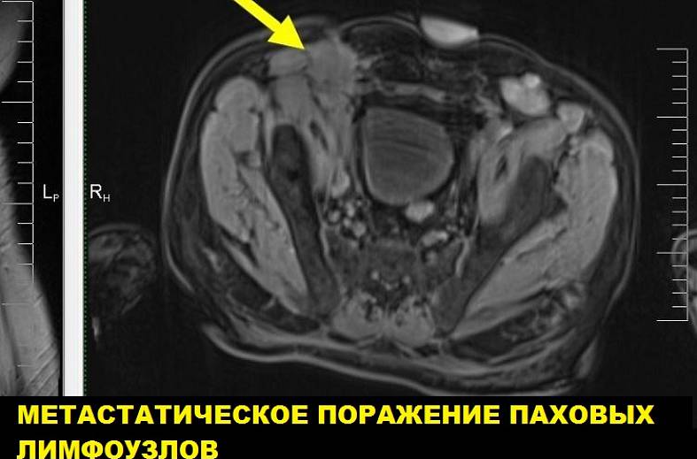 МРТ органов малого таза (простата, мочевой пузырь, семенные пузырьки)