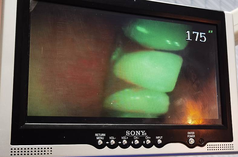 Первичный прием стоматолога с диагностикой интраоральной видеокамерой 