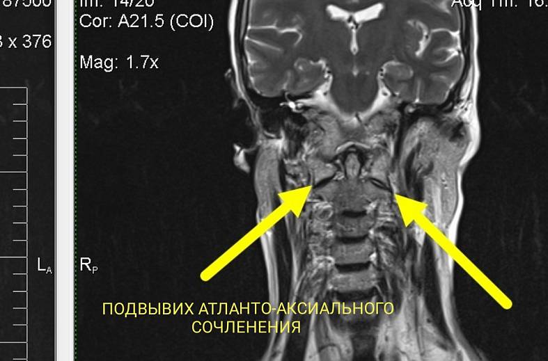 МРТ кранио-вертебрального перехода