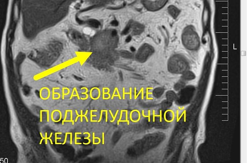 МРТ поджелудочной железы