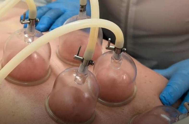 Аппаратный вакуумно-баночный массаж