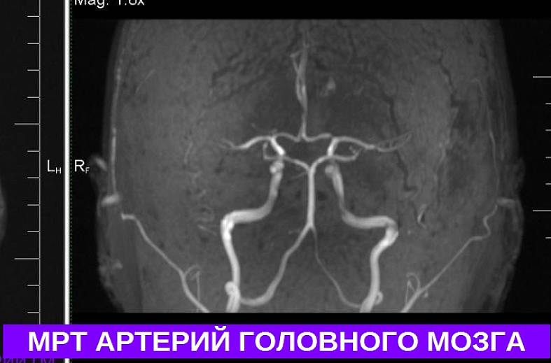МРТ артерий головного мозга