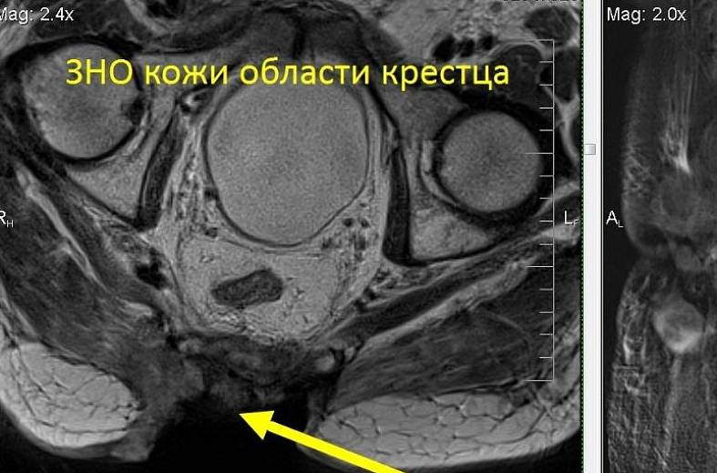 МРТ мягких тканей (одна область)