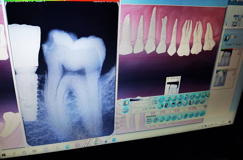 Снимок зуба - визиограмма