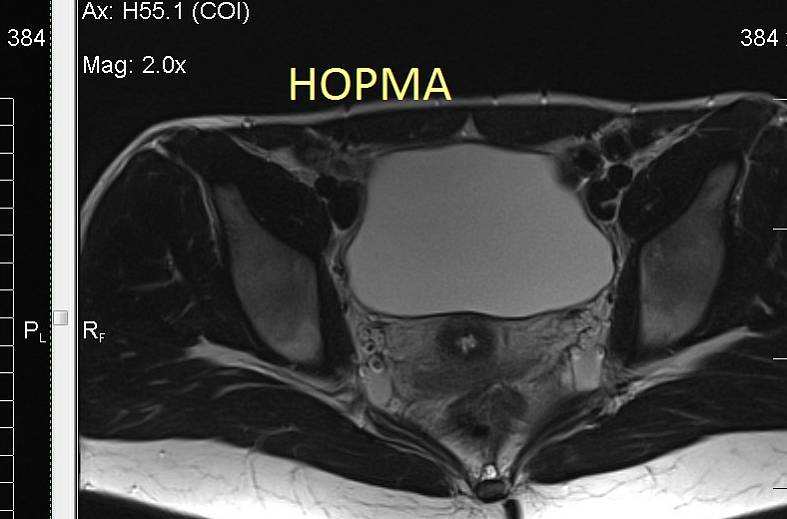 МРТ органов женского малого таза (матка, яичники, мочевой пузырь, влагалище, сосуды малого таза, лимфатические узлы)
