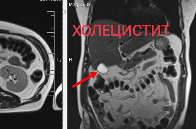МРТ печени, желчного пузыря и холангиография (детальный осмотр внутри и вне печеночных желчных протоков)