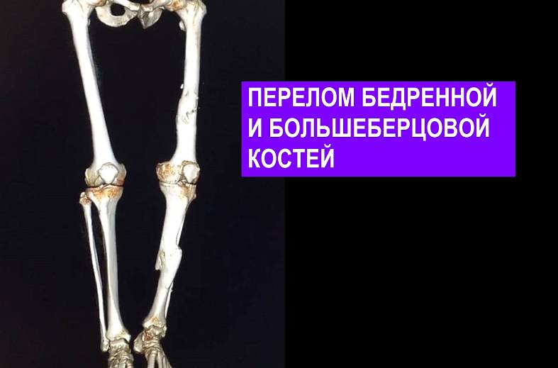 КТ малоберцовой кости