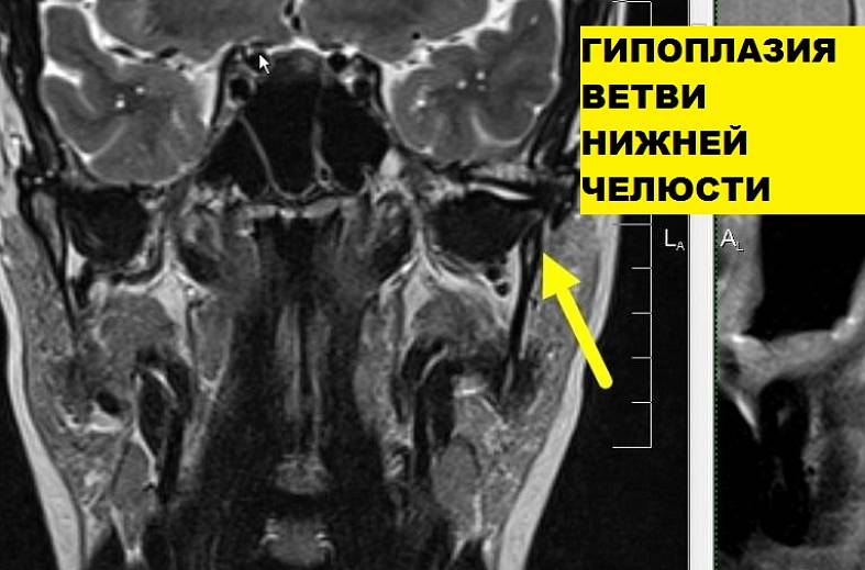 МРТ-исследование височно-нижнечелюстных суставов