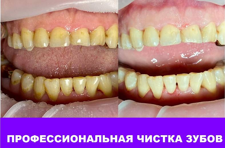 Комплексная чистка одного зуба, ультразвуковая и Air Flow