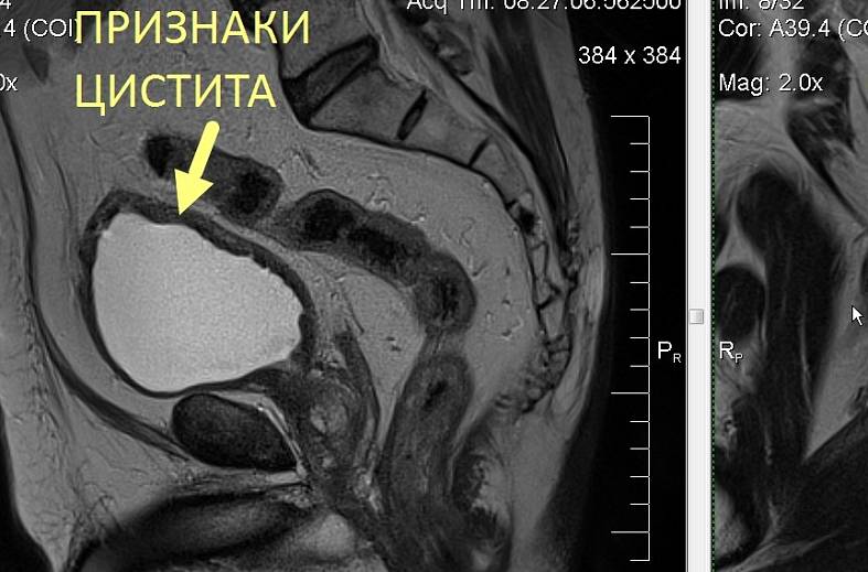 Диффузно-взвешенное магнитно-резонансное изображение (DWI MRI) ( для обеспечивания контрастности картинки)