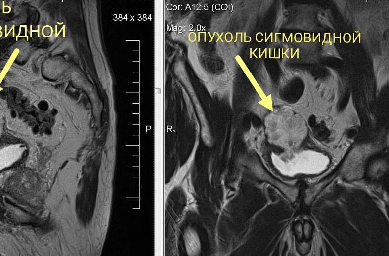 МРТ толстого кишечника (колонография)