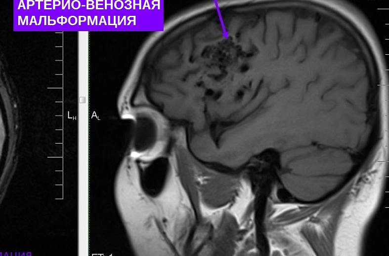 Бесконтрастная МРТ венография головного мозга 