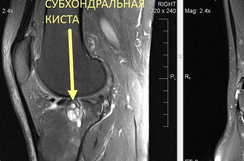 МРТ коленного сустава на 15-канальной катушке