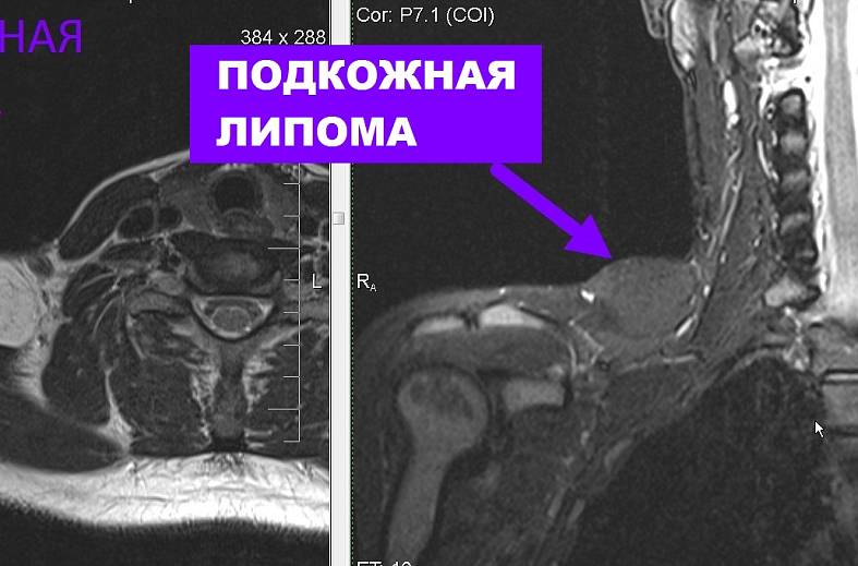 МРТ мягких тканей конечности (одна область)
