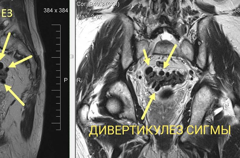 МРТ толстого кишечника (колонография)