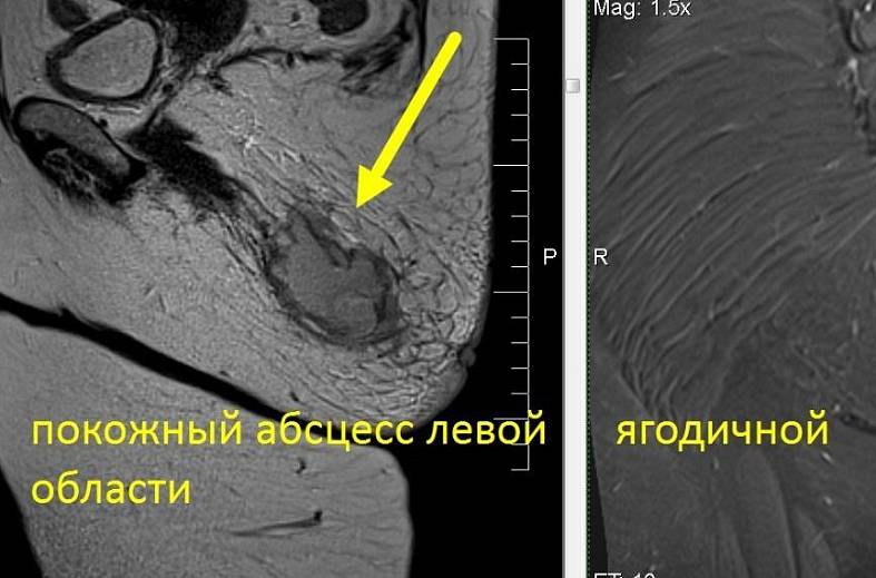 МРТ мягких тканей конечности (одна область)