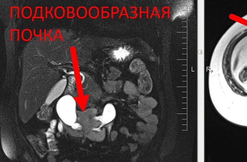 МРТ органов брюшной полости и забрюшинного пространства (печень, поджелудочная железа, селезенка, желчный пузырь, почки, надпочечники) 