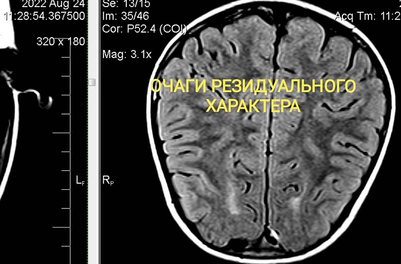 Высокопольная МРТ головного мозга по программе эпилептологического сканирования