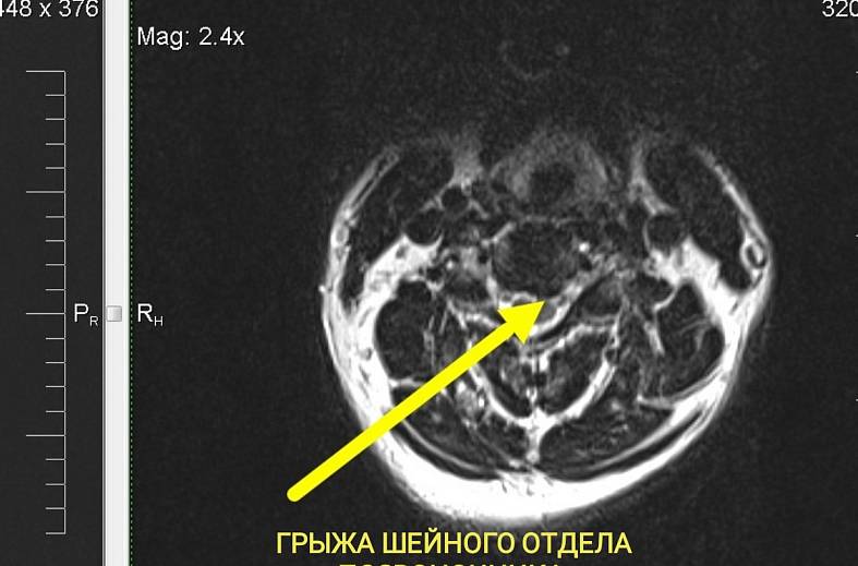 МРТ шейного отдела позвоночника и ангиография артерий шеи