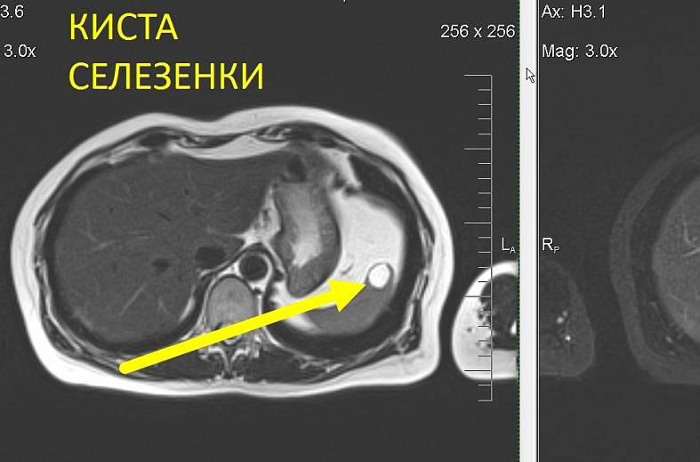 МРТ органов брюшной полости и забрюшинного пространства (печень, поджелудочная железа, селезенка, желчный пузырь, почки, надпочечники) 